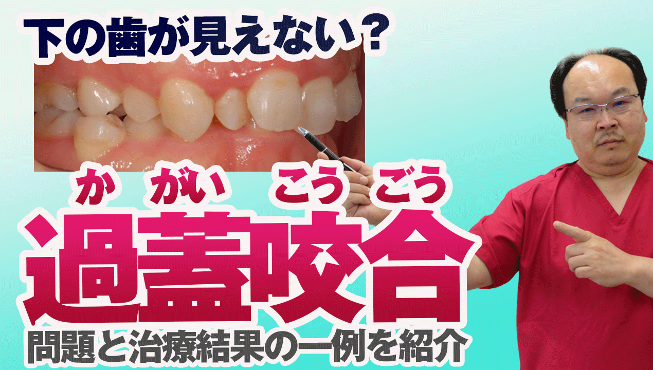 下の歯が見えない？過蓋咬合の問題と治療結果の一例を紹介