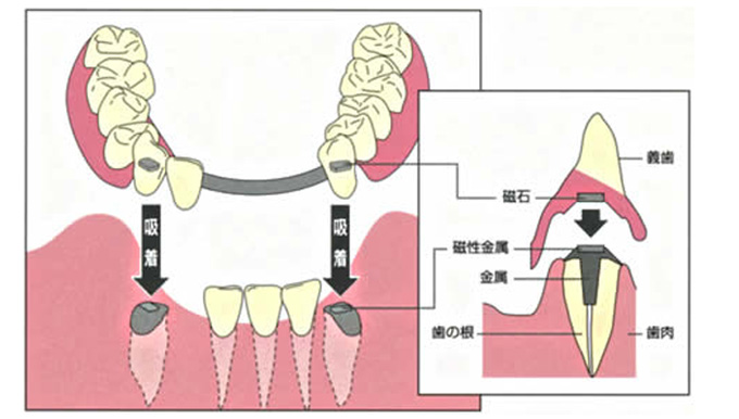 公園前中山歯科での審美義歯の症例