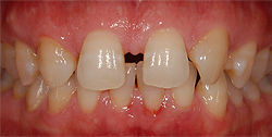 前歯の審美修復　治療前