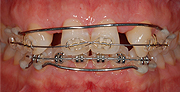 上顎前歯は2本のインプラントを支えに4本のセラミックス