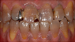 前歯の審美修復　治療前