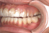 就寝時はノンクラスプ義歯の上からプロテクションスプリントを入れます