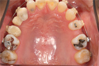 歯の歯の間が大きく空いているので矯正治療します