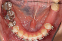 左下の歯の欠損部位は、矯正後、インプラント予定です。