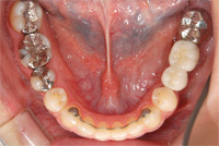 左下には2本のインプラントが入っています。前歯の裏には矯正後の安定装置をセットしています。