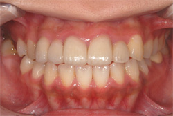 前歯の審美修復　治療後