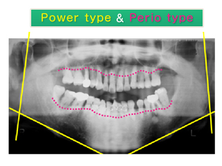 重度の歯周病に強い力が加わり、保存不可能な歯が多い