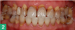 歯周病治療で改善。