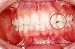 前歯の矯正治療　治療前