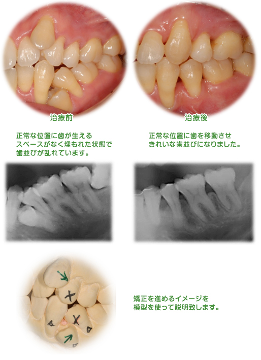 乳歯を抜いて、永久歯を正しい位置に矯正。上の方にある永久歯を正しい高さに。