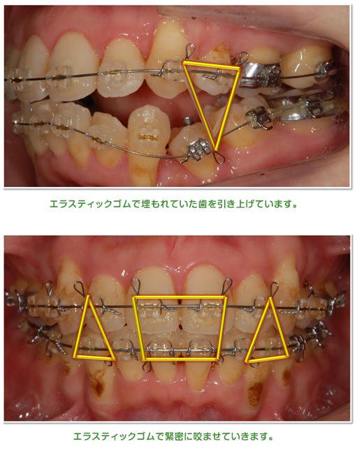 乳歯を抜いて、永久歯を正しい位置に矯正。上の方にある永久歯を正しい高さに。