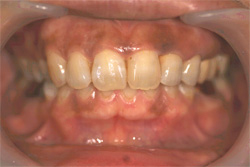 前歯の審美修復　治療後