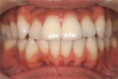 ホワイトニング後の白い歯
