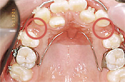 歯を抜き、そのスペースを利用した前歯の乱ぐい凸凹を治します