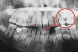 部分的な歯の矯正　治療前