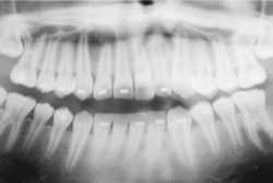 部分的な歯の矯正　治療後