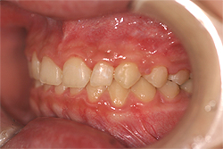 矯正治療により、歯列が美しくなりました。